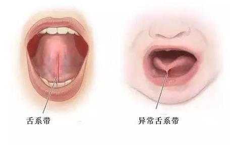 孩子说话不清楚怎么办？大舌头能治吗？